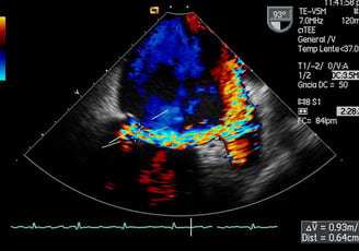 ecocardiograma doppler adulto morelia dicava