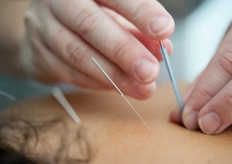 Wednesfield Acupuncture Clinic