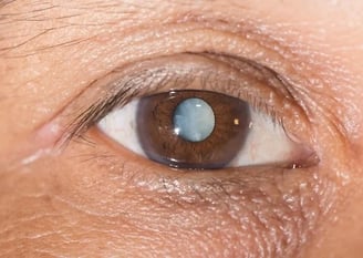 Close de um olho com catarata avançada, evidenciando a opacificação do cristalino