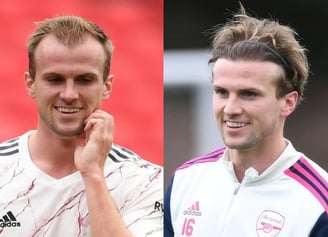 Rob Holding hair transplant