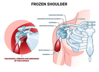 Best Shoulder Pain Treatment In Kochi, Kerala