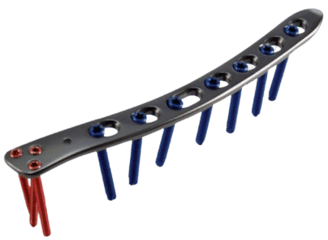 Placa para Húmero Distal Lateral