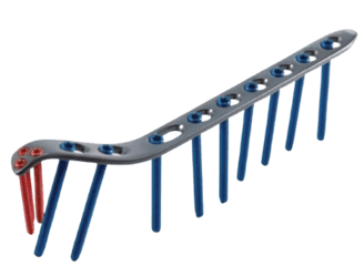 Placa para Húmero Distal Medial