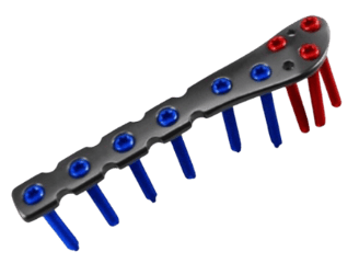 Placa para Peroné Distal Lateral