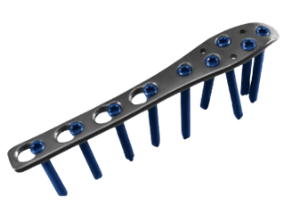 Placa para Peroné Distal