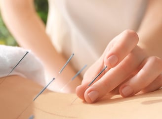 acupuntura. saúde natural. dry needling. medicina chinesa. terapias naturais. dor crônica