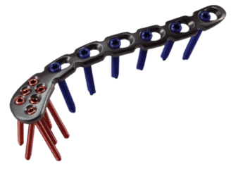 Placa para Clavícula para Extremidad Acromial