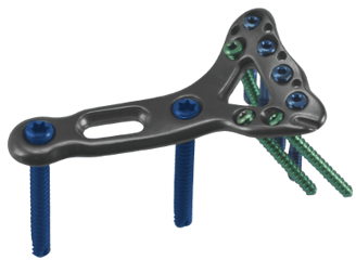 Placa para Radio Distal Medial (YAP)