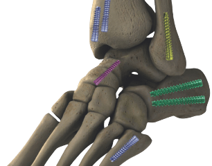 Tornillo Canulado de Doble Compresión