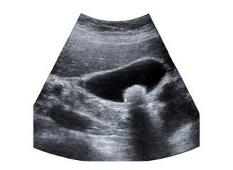 Ultrassom de abdome com cálculo na vesícula biliar