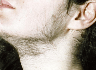 hirsutism condition
