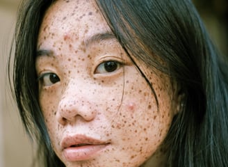 freckled face