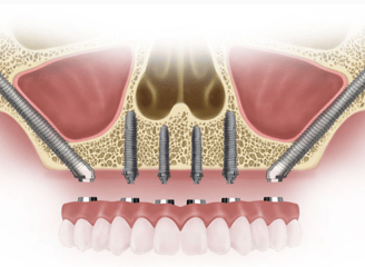 a dental implanting procedure for implanting teeth