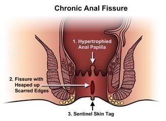 anal fissure GASTRO FOUNDATION