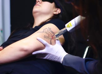 remoção de tatuagem no braço com laser