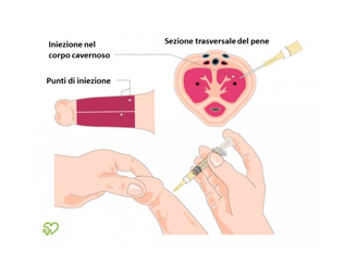 iniezione intracavernosa del pene di prostaglandine