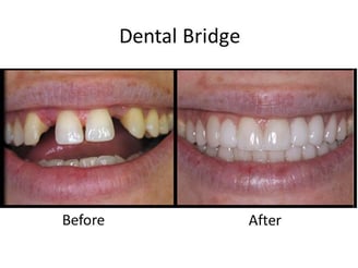 missing teeth
