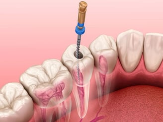 Instrumentação canal em Dentista 24 horas