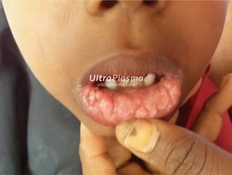 ultraplasma.com_wart_treatment_sigil_tedavisi_ultra_plasma_ultra_plazma_mouth_agiz
