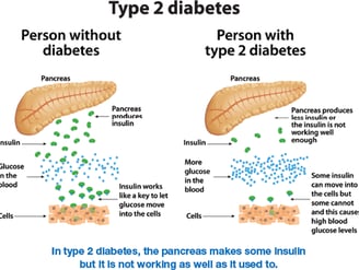 Type 2 diabetes