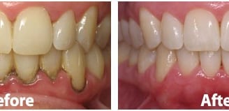 scaling and polishing in baner