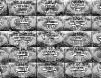 all-on-x panoramic x-ray
