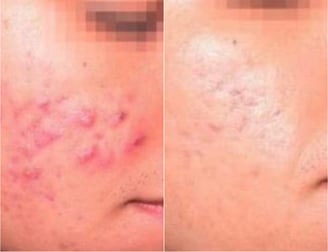 Resultado de tratamiento con láser para acné severo: mejora en textura y manchas