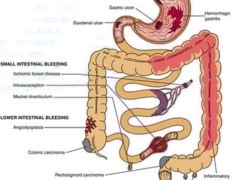 Gastrointestinal (GI) bleeding GASTRO FOUNDATION