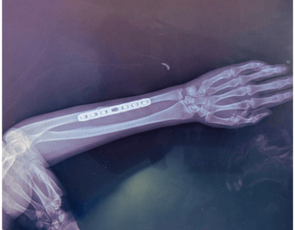 Placa recta para radio y cúbito