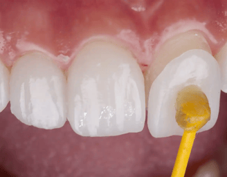 Faccette dentali, denti bianchi