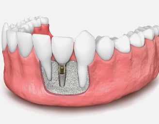 a dental implanting implanting a toothbrush and a toothbrush