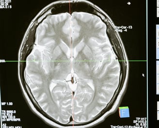 Vista de pantalla de monitor mostrando un corte sagital de cerebro