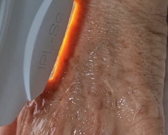 Luz Intensa Pulsada