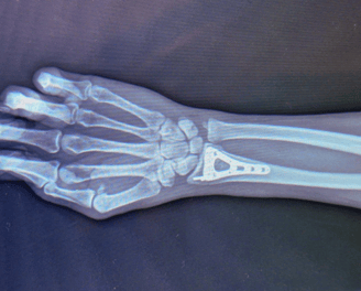 Placa para radio distal con ángulo variable