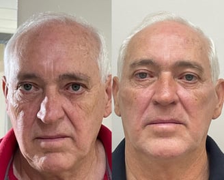 biostimulador e colageno