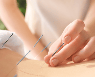 acupuntura. saúde natural. dry needling. medicina chinesa. terapias naturais. dor crônica