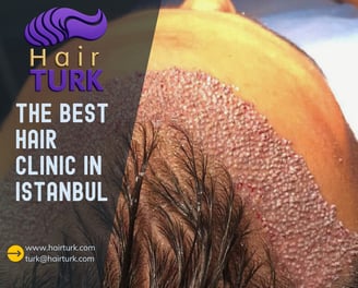 HairTurk, best hair clinic in Istanbul, showing hair transplant procedure with scalp and new growth