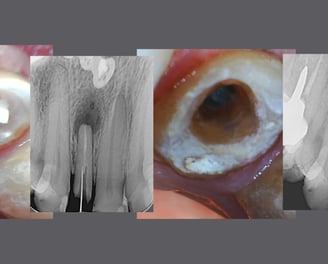 sequencia de fotos clínicas e radiografias de remocao de pino de fibra