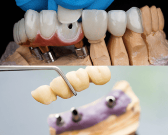 Dental crowns and bridges in navi mumbai | Ekdantam Dental Clinic kopar khairane