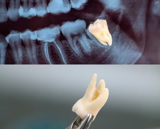 best wisdom tooth extraction | Ekdantam Dental Clinic kopar khairane