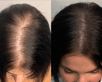 Best Scalp Micropigmentation Toronto_ATRUBARBER