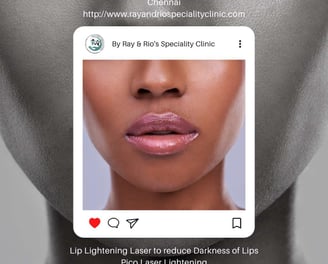 Dark Lips - Lip Lightening ray and rio's speciality clinic