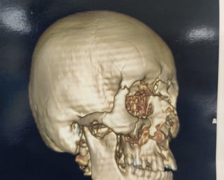 Facial fracture after car accident