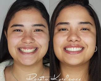 antes e depois