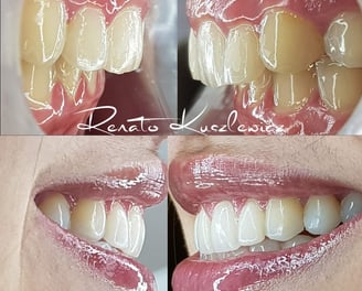 Antes e depois