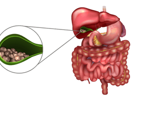 Cálculos na vesícula biliar