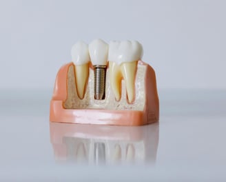 dent parodontale, saine, implant dentaire