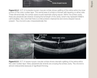 OCT com edema macular
