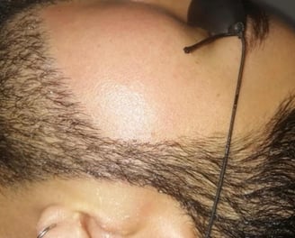 Resultados de depilación láser facial en hombre con barba: reducción visible del vello