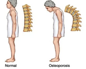 Get Osteoporosis Treatment From Dr.Shalini in Hyderabad